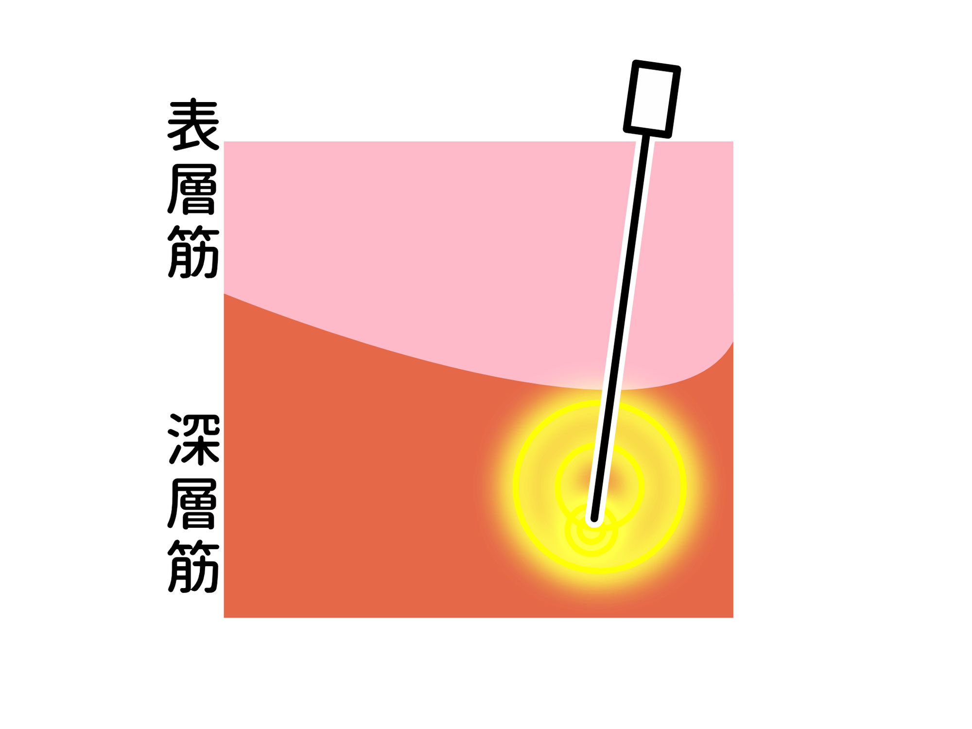 腰痛に鍼灸④