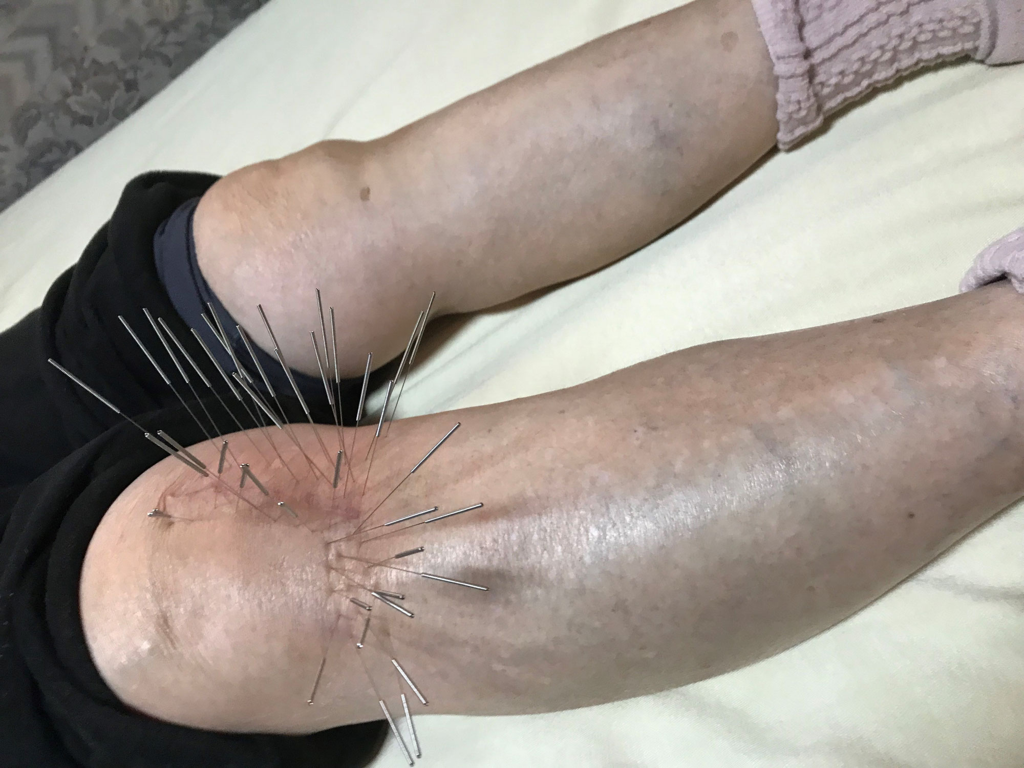膝関節の手術後のルート治療