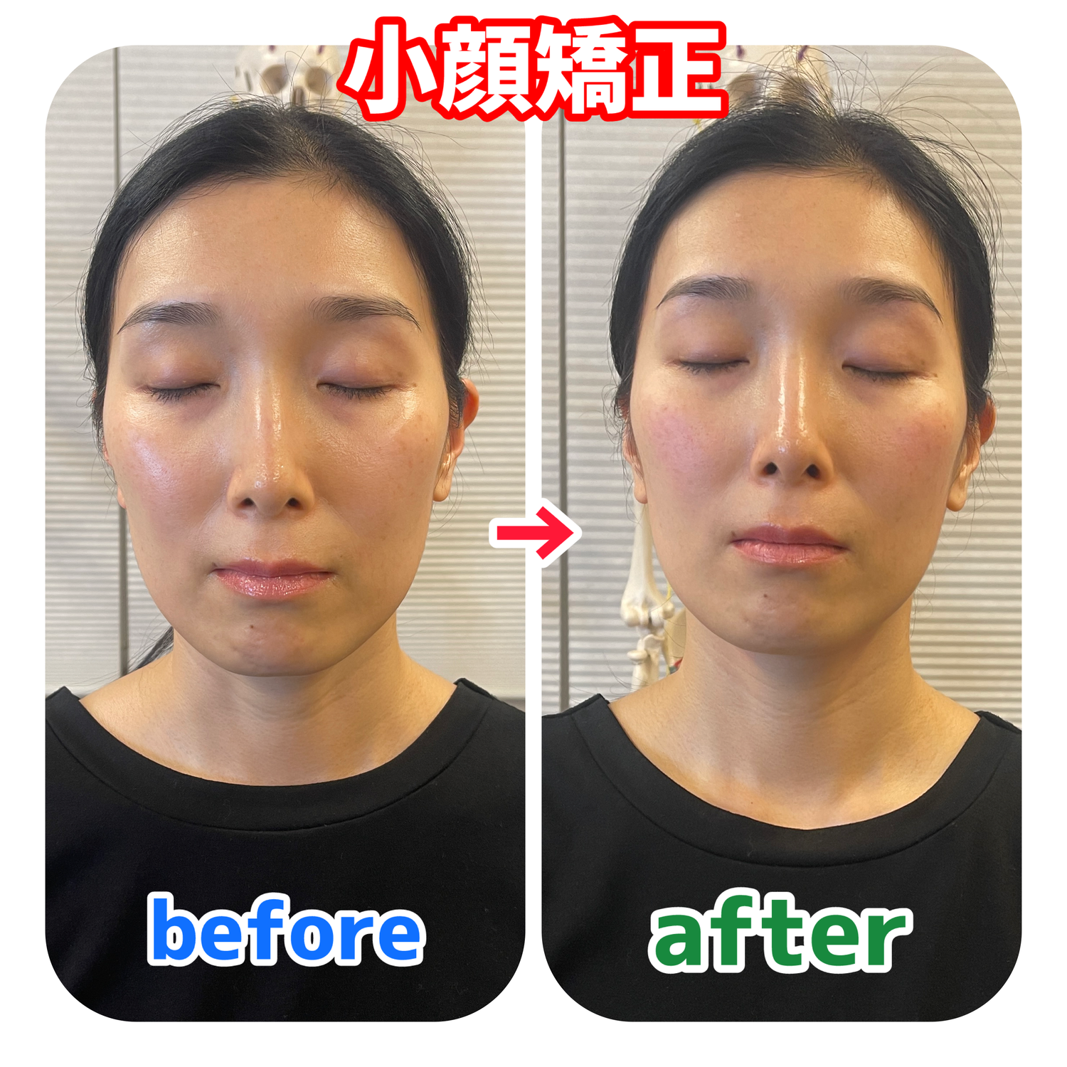 当院の「小顔矯正」の実例