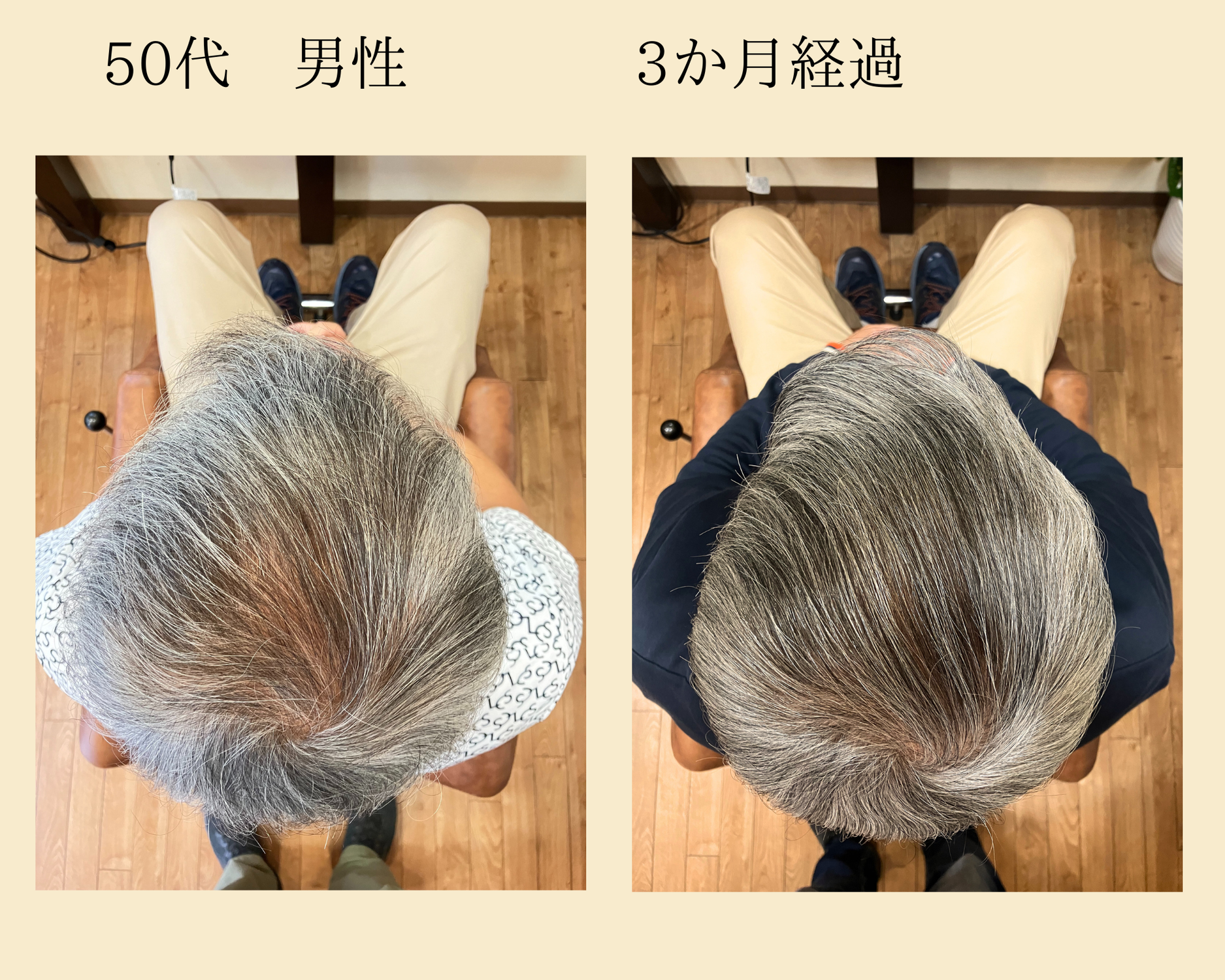 発毛コース