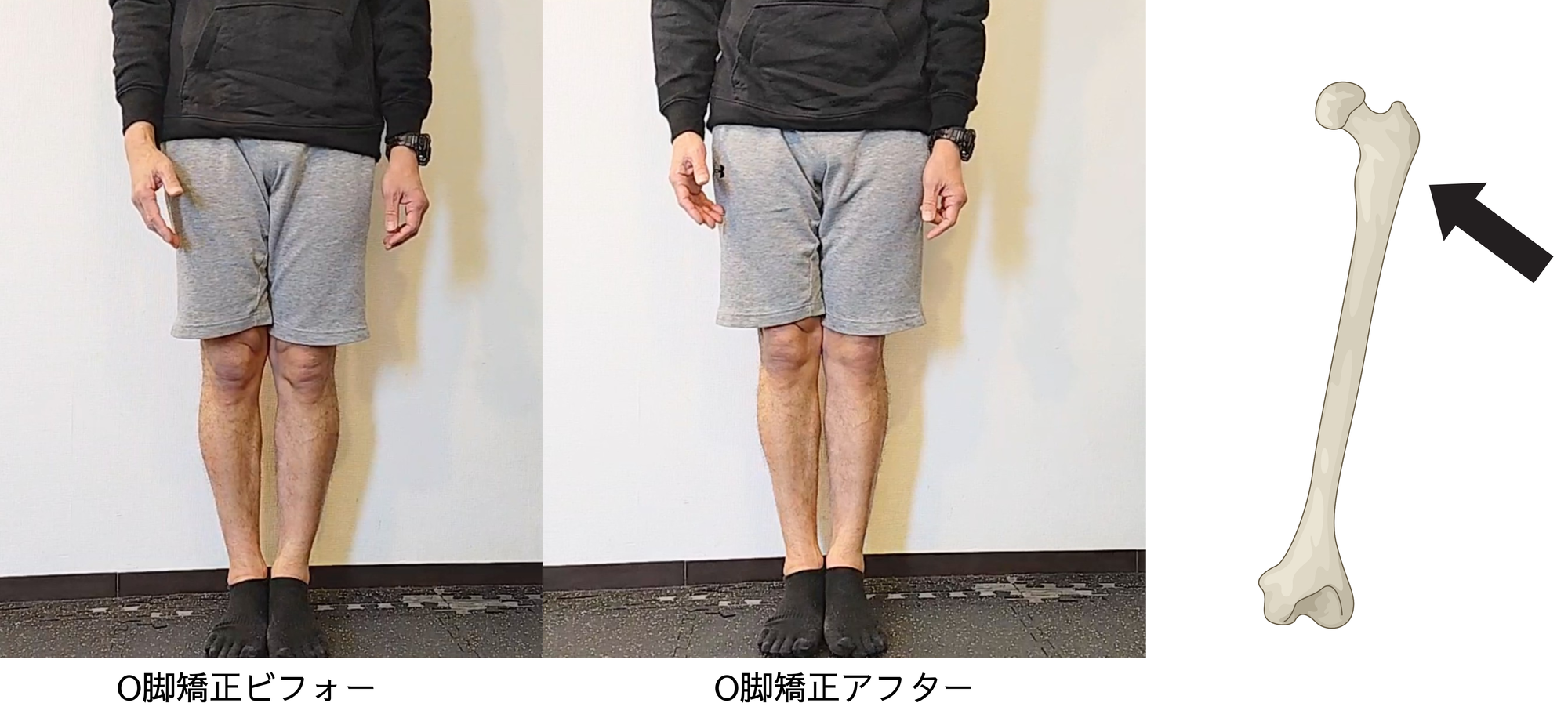 O脚矯正はすごく簡単です