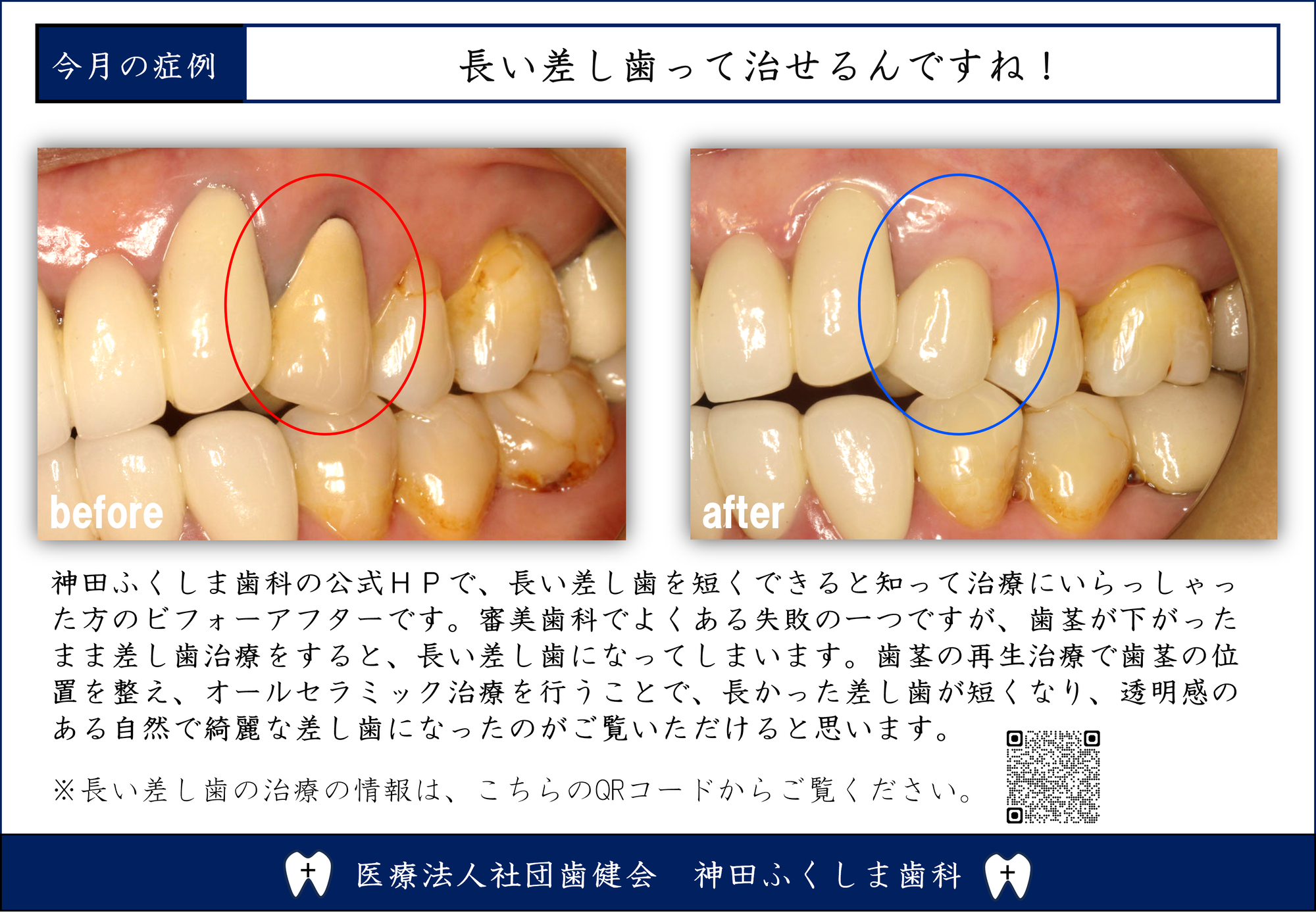 歯ぐきの黒ずみの原因と治療法｜セラミック交換だけでは治らないケース