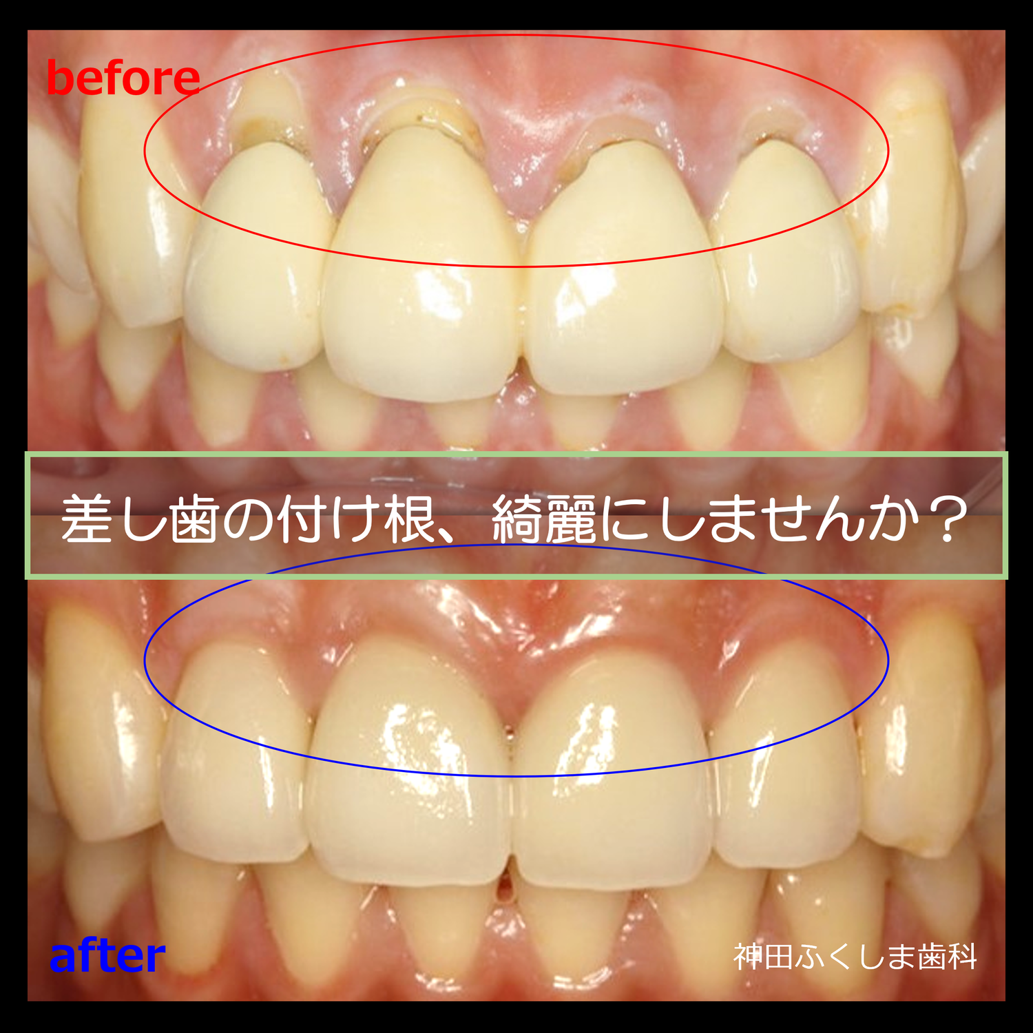 古い差し歯のやり直し｜オールセラミックと歯ぐきの再生治療ページの解説ブログ