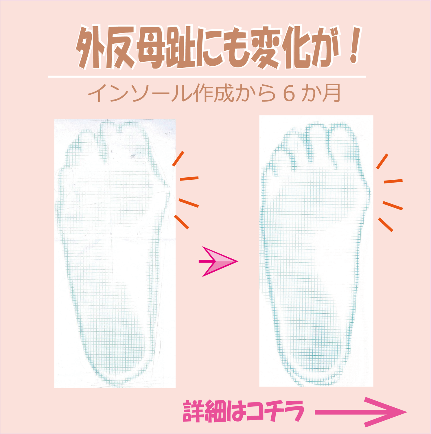 外反母趾の変化
