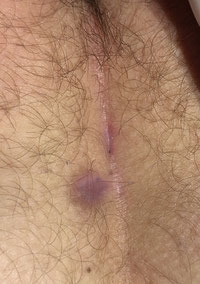 wound after sinusectomy