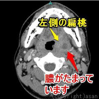 扁桃周囲膿瘍