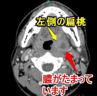 扁桃周囲膿瘍