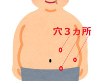 腹腔鏡手術での穴の場所 3ヵ所のイラスト
