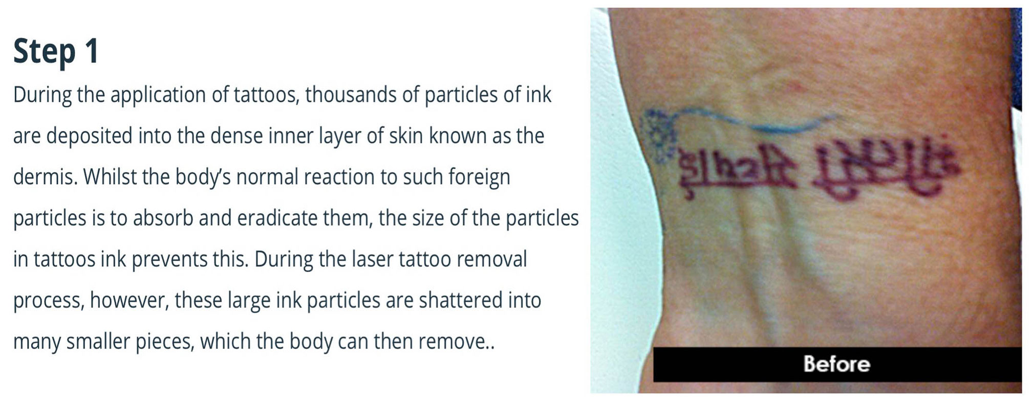 LASER TATTOO REMOVAl - Welcome to Amin`s Angel Tattooz and piercings studio, training and tattoo material supply in Hyderabad. LASER TATTOO REMOVAl - Welcome to Amin`s Angel Tattooz and piercings studio, training and tattoo material supply in Hyderabad.