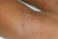 eczema sur peau foncee