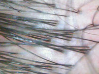 薄毛克服体験記ブログ12月27日の店長の後頭部の頭皮の拡大写真