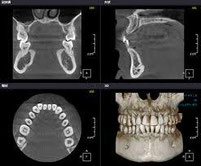 CT検査で詳しい歯周病診断