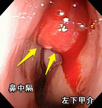 左鼻腔血管腫
