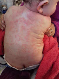 photo d'un dos de bebe couvert de plaques rouges d eczema
