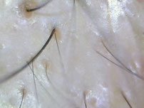 薄毛克服体験記ブログ5月24日の店長の生え際の頭皮の拡大写真