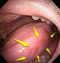 お口のできもののチェック 舌のできもの 癌 心配 熊本 くまモンファン 耳鼻咽喉科医の みみ はな のど あれこれ