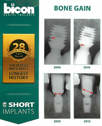 Knochenzuwachs an kurzen Bicon Implantaten nach prophetischer Versorgung 