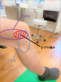 外反母趾とひざ痛