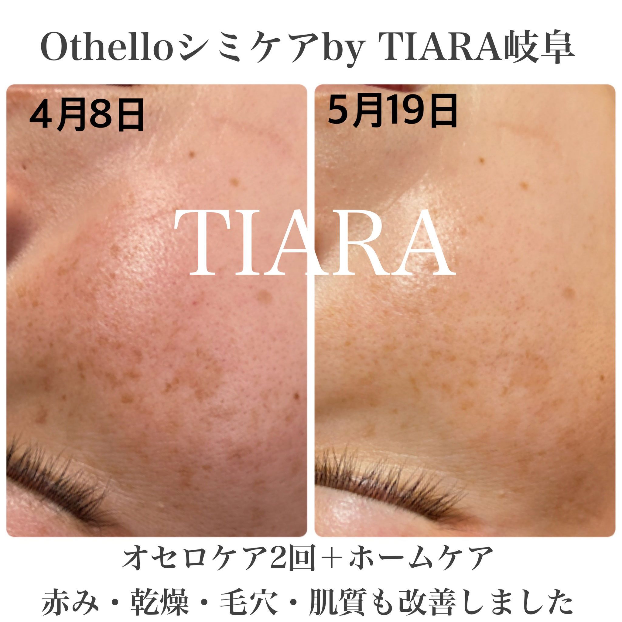 黒を白にかえる - 岐阜のプライベートエステサロンTIARA 黒を白にかえる - 岐阜のプライベートエステサロンTIARA