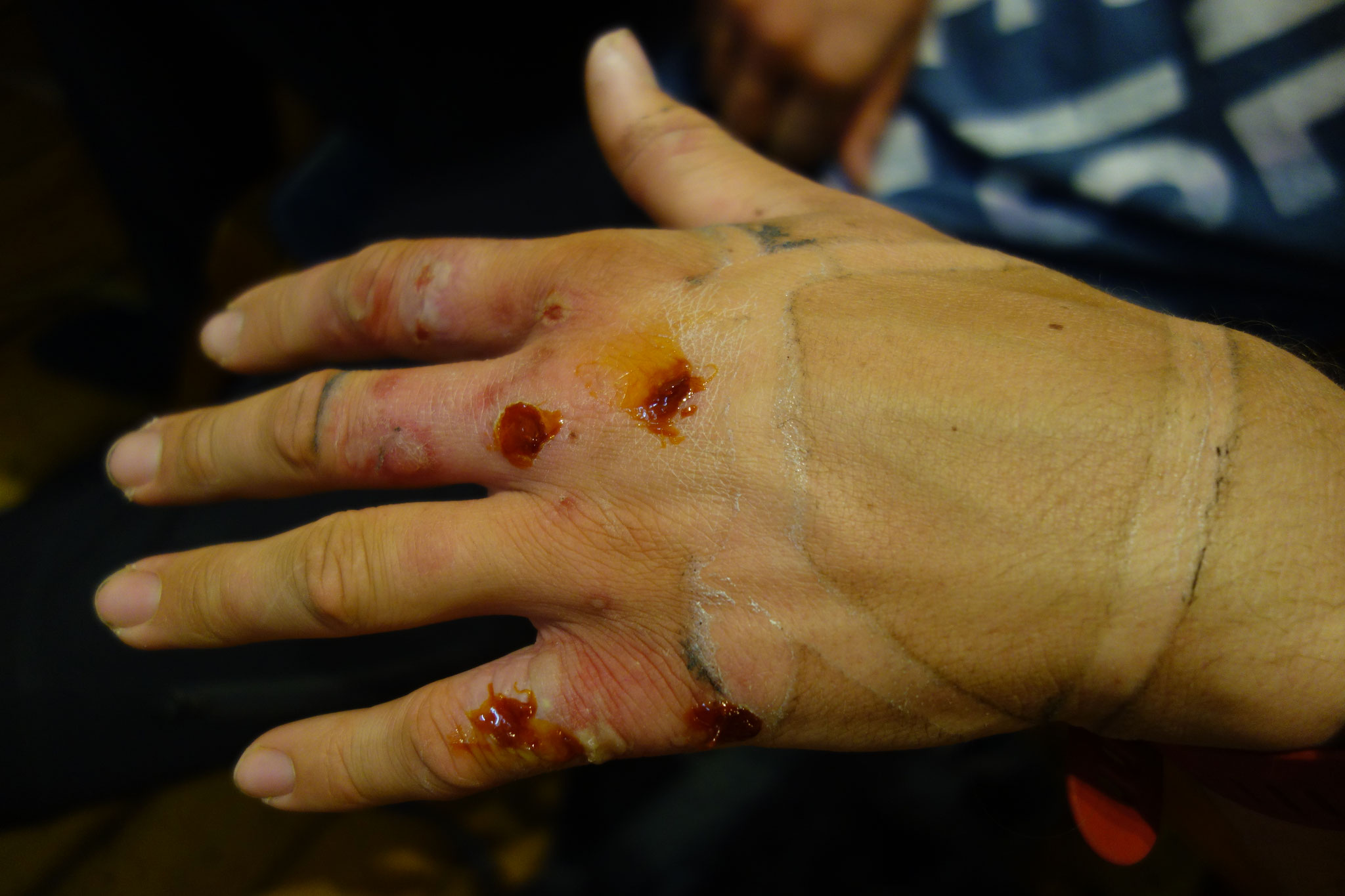 The only injury which is worth mentioning - Jens' hand 