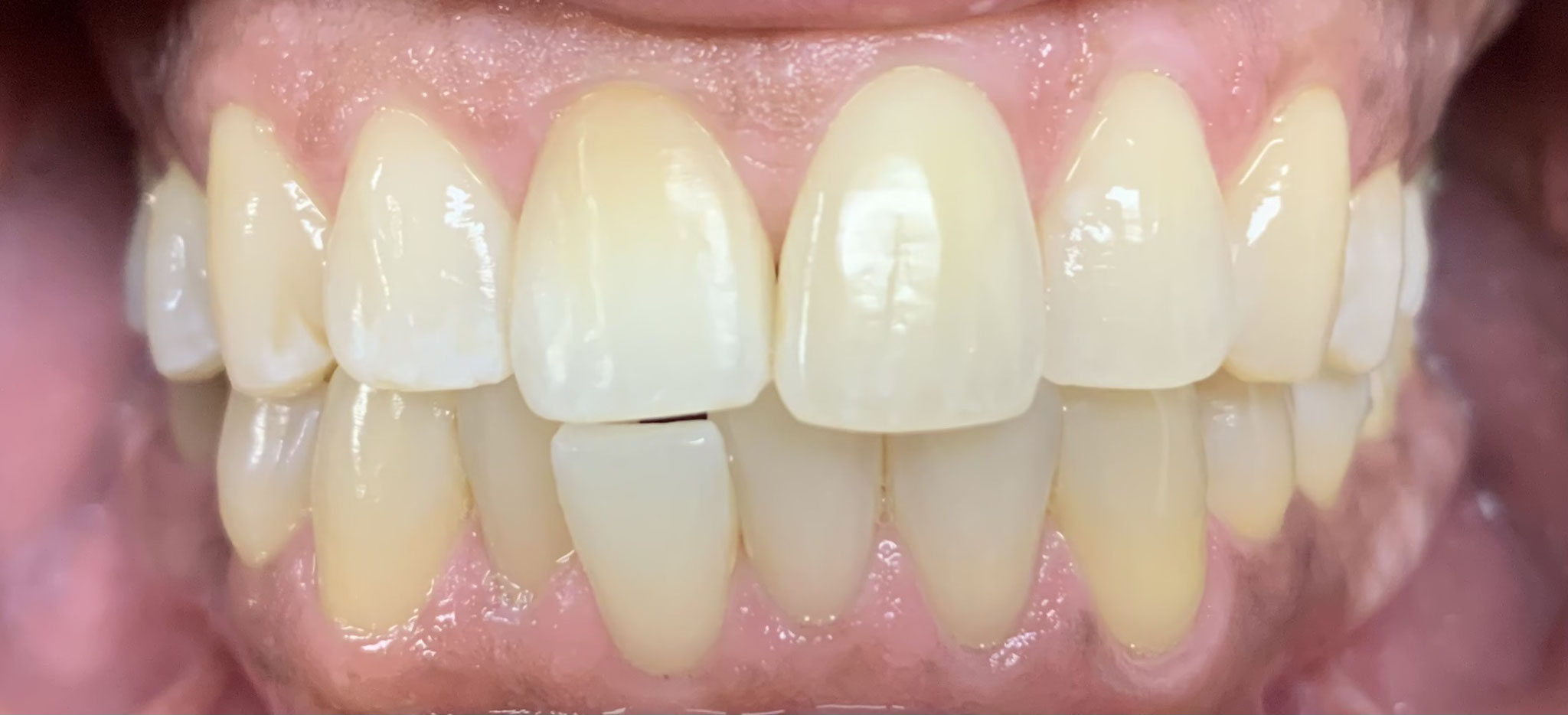 AFTER | Internal whitening dead dark front tooth