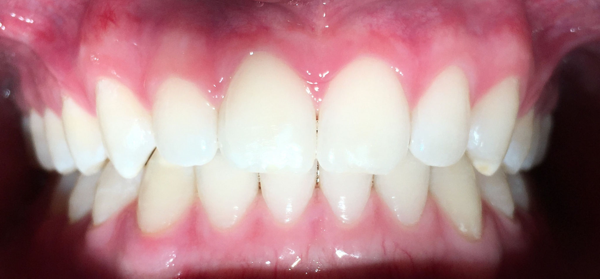 AFTER | Invisalign treatment