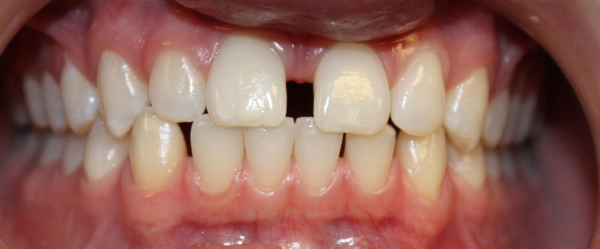 BEFORE | Invisalign treatment patient had severe gapping