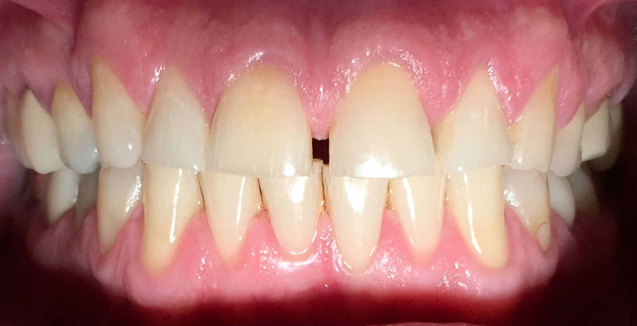 BEFORE | Cosmetic veneers. Patient had severe gapping and wear