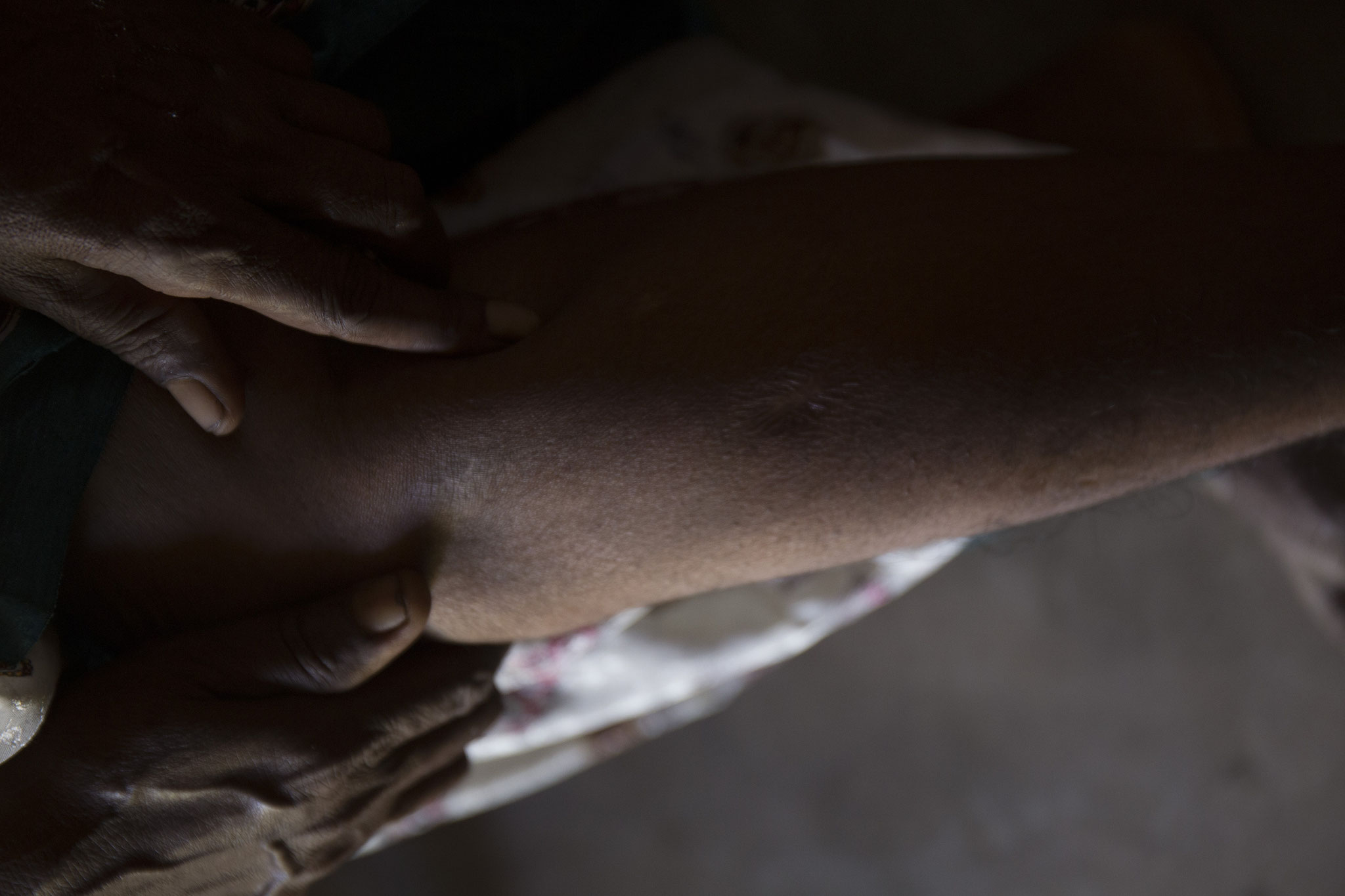 Auf der Flucht vor dem Bürgerkrieg wurde Annalaxmi von Granatsplittern getroffen. Eine Narbe von vielen ist an ihrem Schienbein zu sehen. Vavuniya 2018