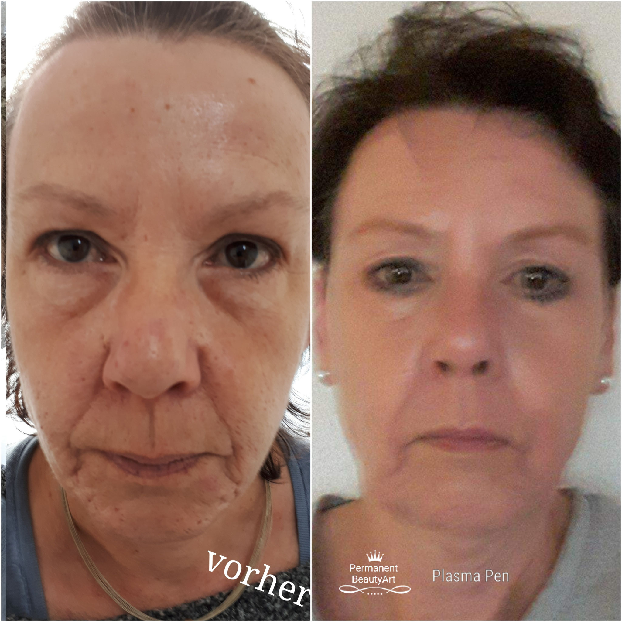 Plasma Pen Gesicht Anti-Aging 