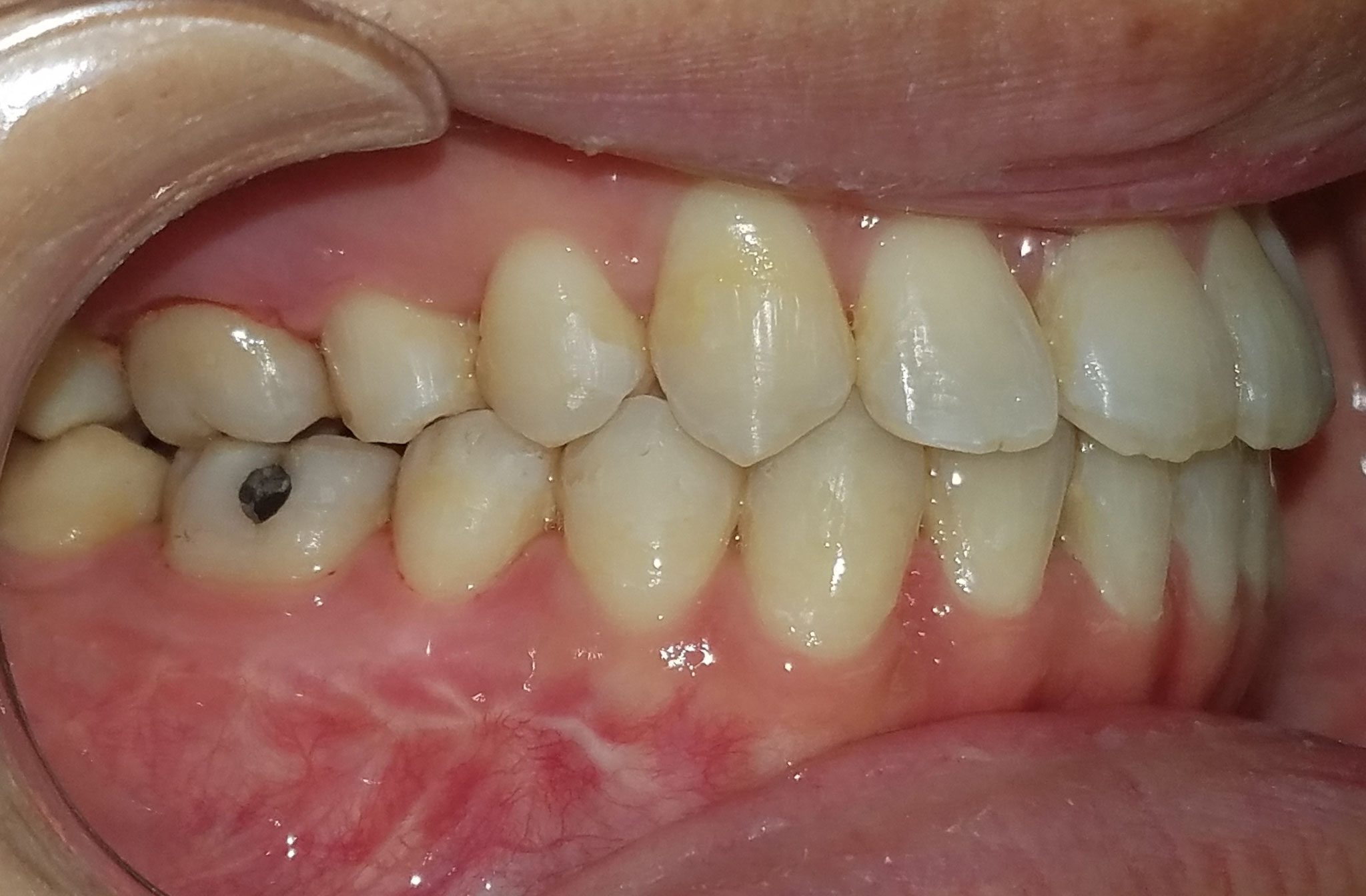 Orthognathic Jaw Surgery in Allen TX Suncreek Orthodontics in Allen