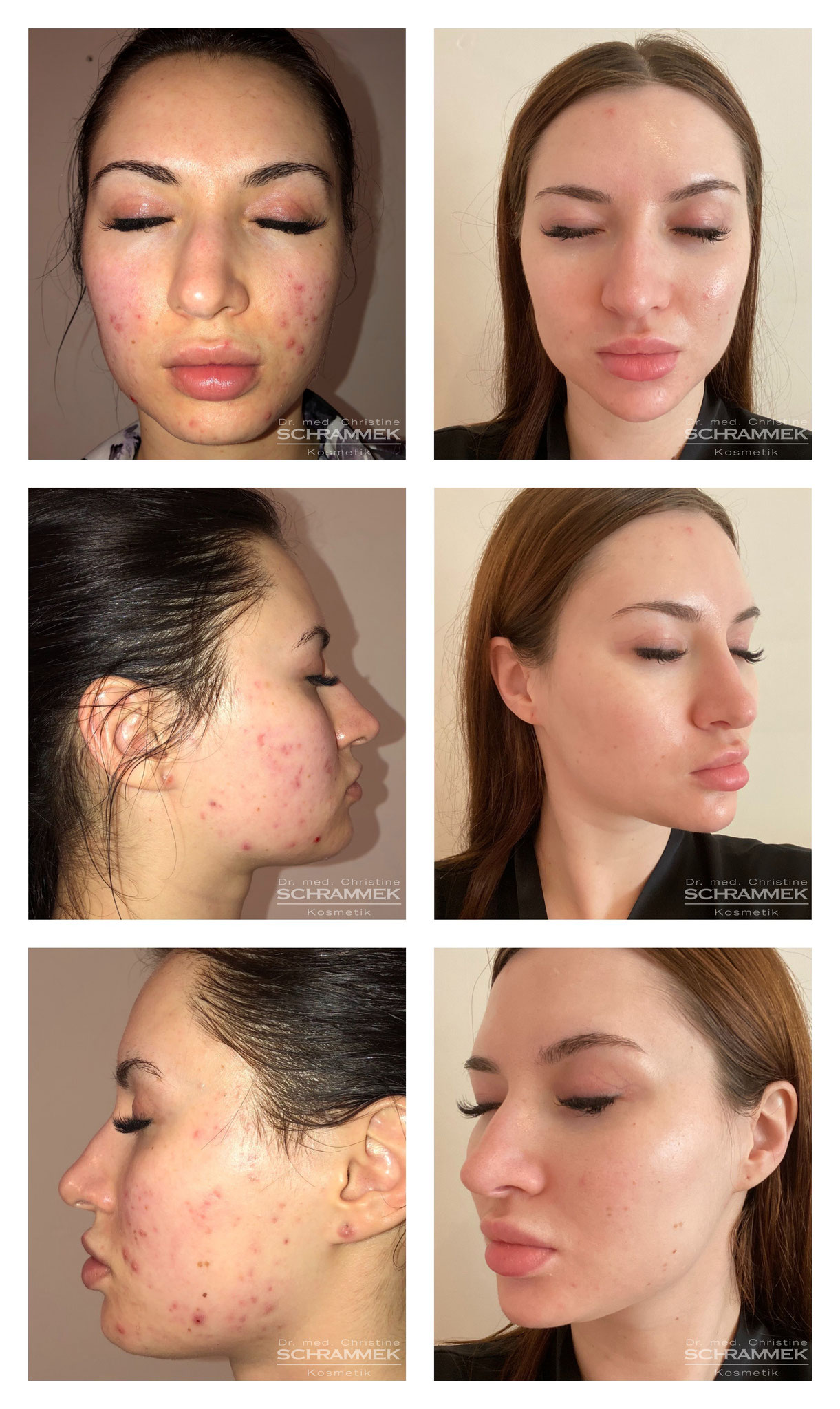 Haarentfernung kosmetikbedarf Gesichtsbehandlung Antiaging needling GreenPeel Microdermabrasion LPG Endermologie Akne Gesichtsbehandlung Sofrischweiz Aknebehandlung Fusspflege Farblichttherapie kosmetik Gesichtsbehandlung Aknebehandlung Akne LPG Lymphomat
