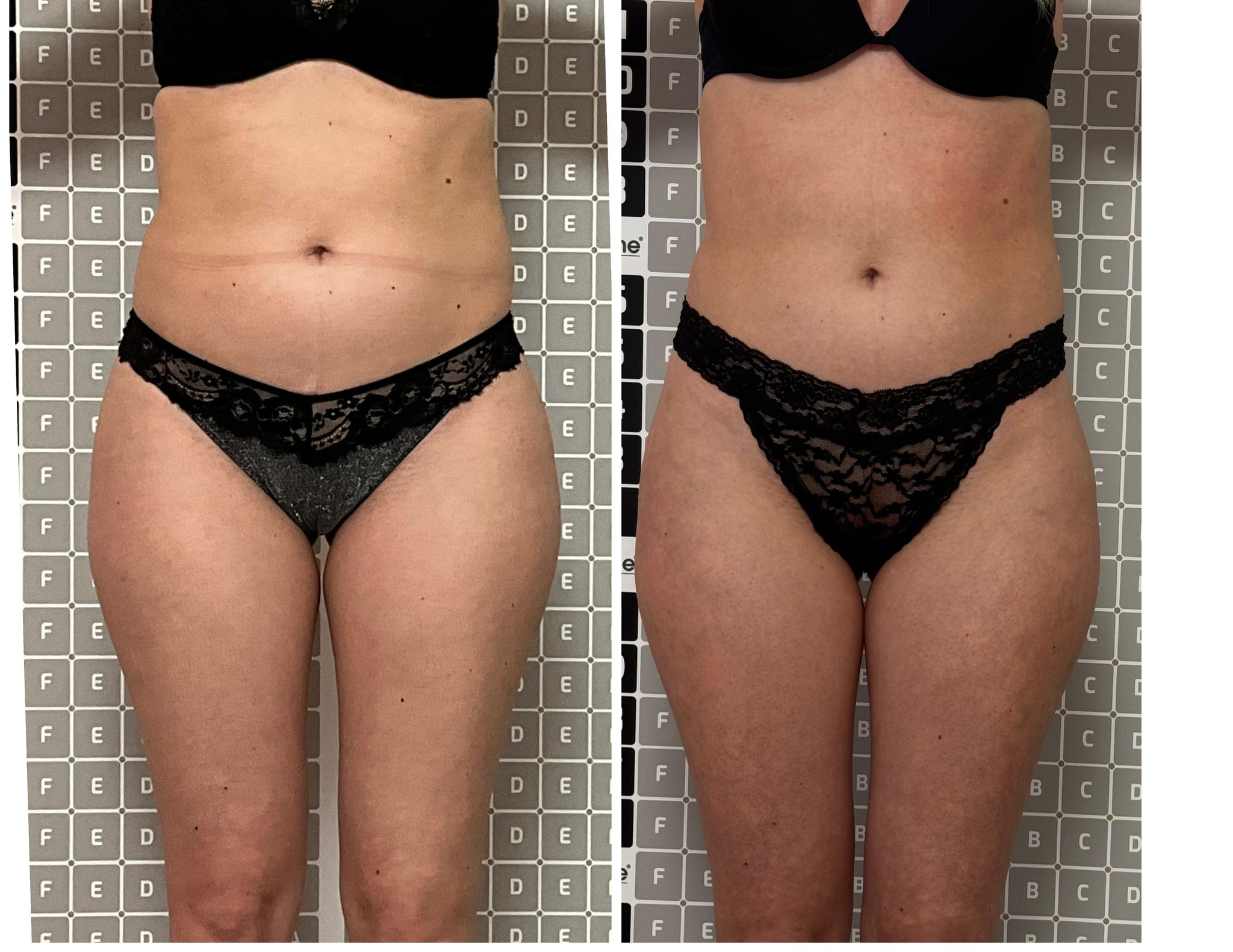 Vorher-Nachher: Hautstraffung mit Liposana 3 Plus im Beauty Studio Dortmund
