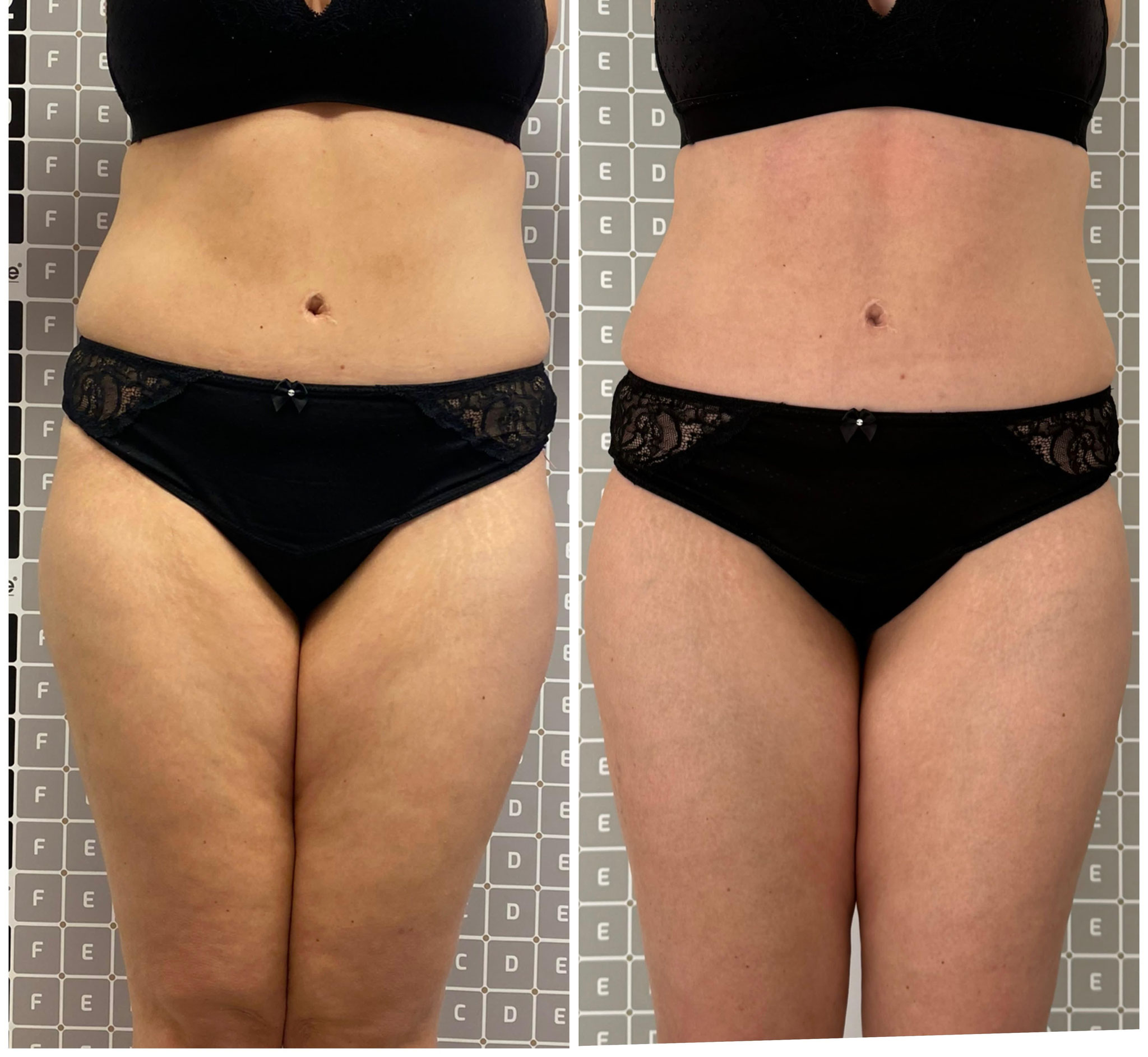 Vorher-Nachher: Körperformung mit Liposana 3 Plus bei Bella's Beauty in Dortmund