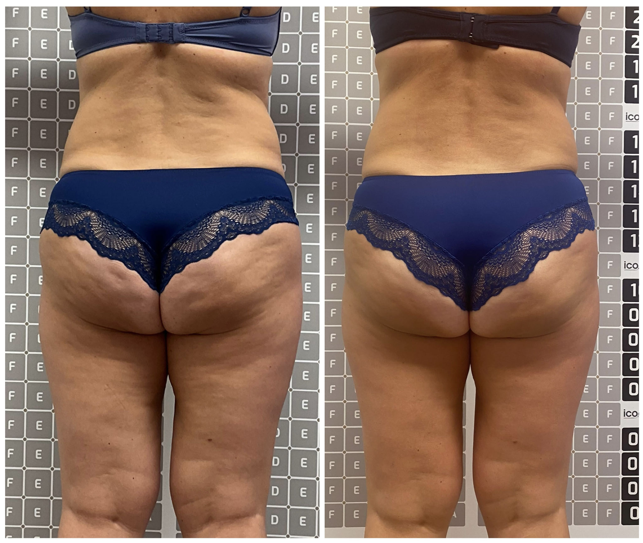 Vorher-Nachher: Körperkonturierung mit Liposana 3 Plus bei Bella's Beauty Dortmund