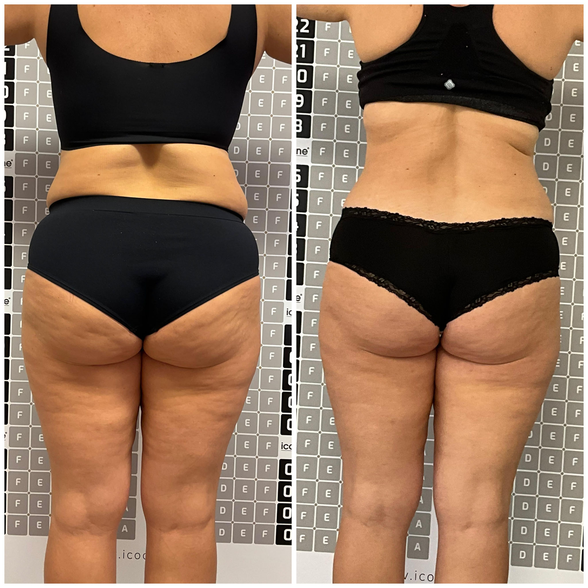 Vorher-Nachher: Fettreduktion am Po mit Liposana 3 Plus, Bella's Beauty Dortmund