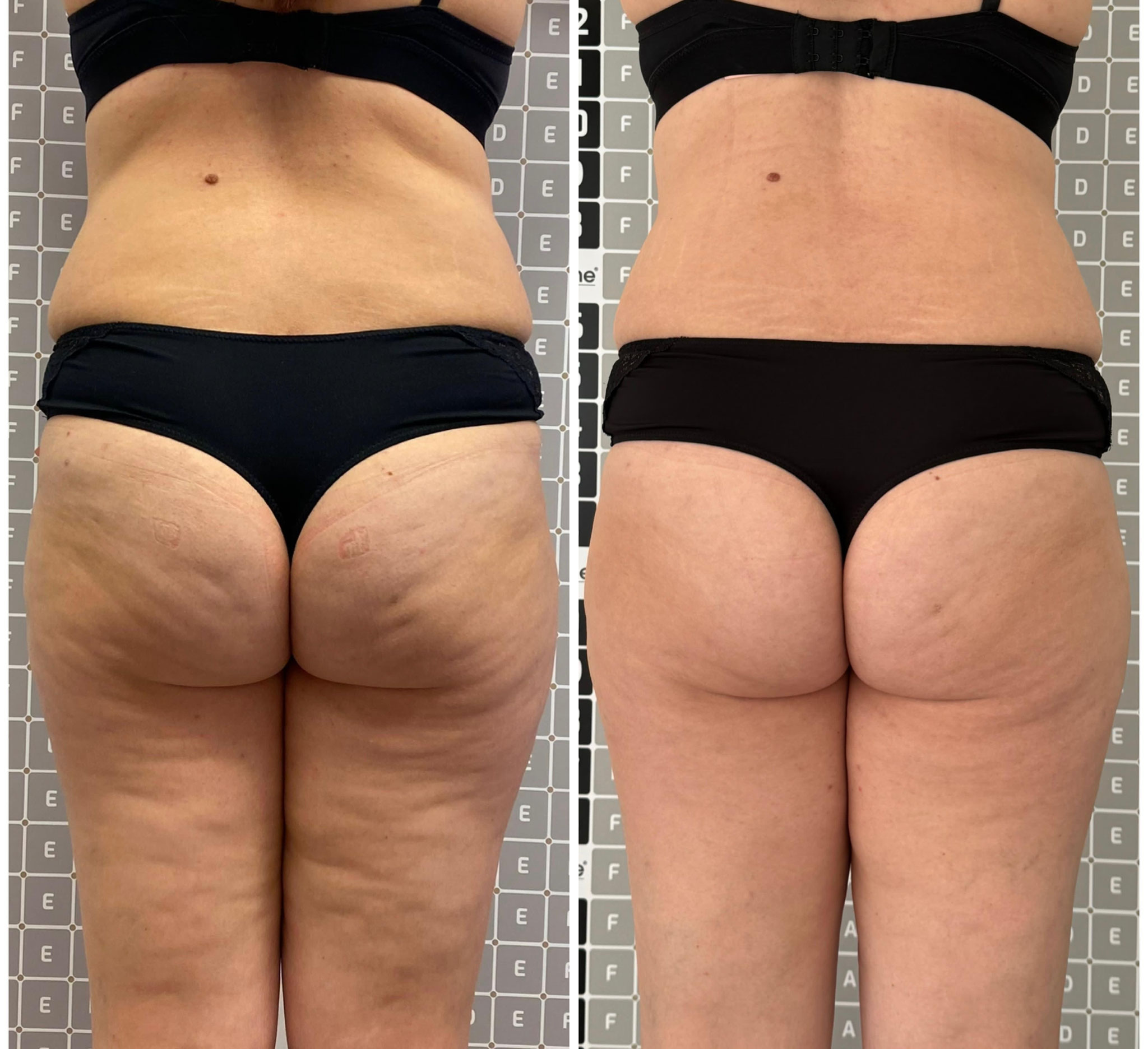 Vorher-Nachher: Cellulite-Reduktion mit Liposana 3 Plus an den Oberschenkeln, Bella's Beauty Dortmund