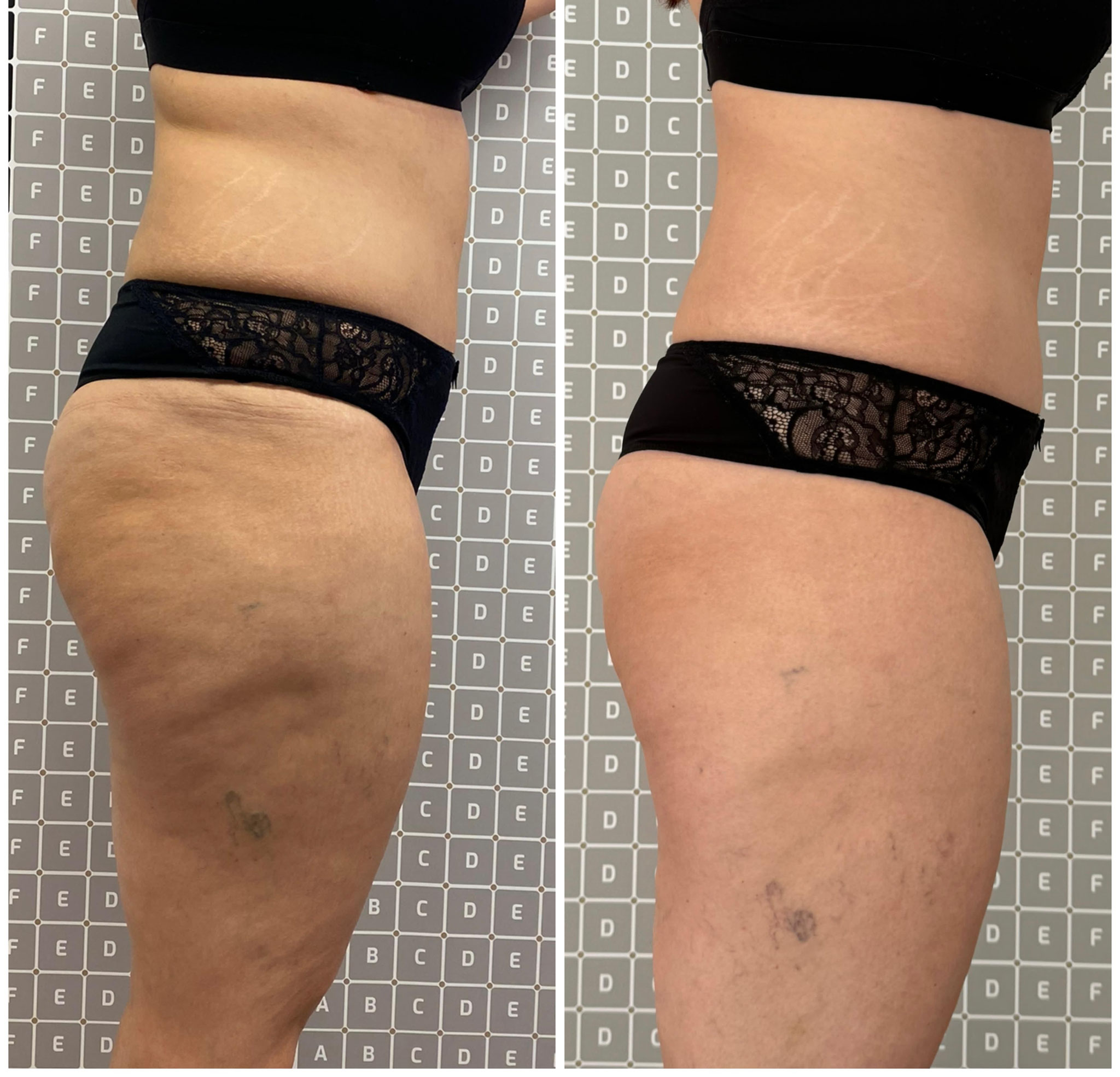 Vorher-Nachher-Ergebnis einer Liposana 3 Plus Behandlung zur Fettreduktion bei Bella's Beauty in Dortmund
