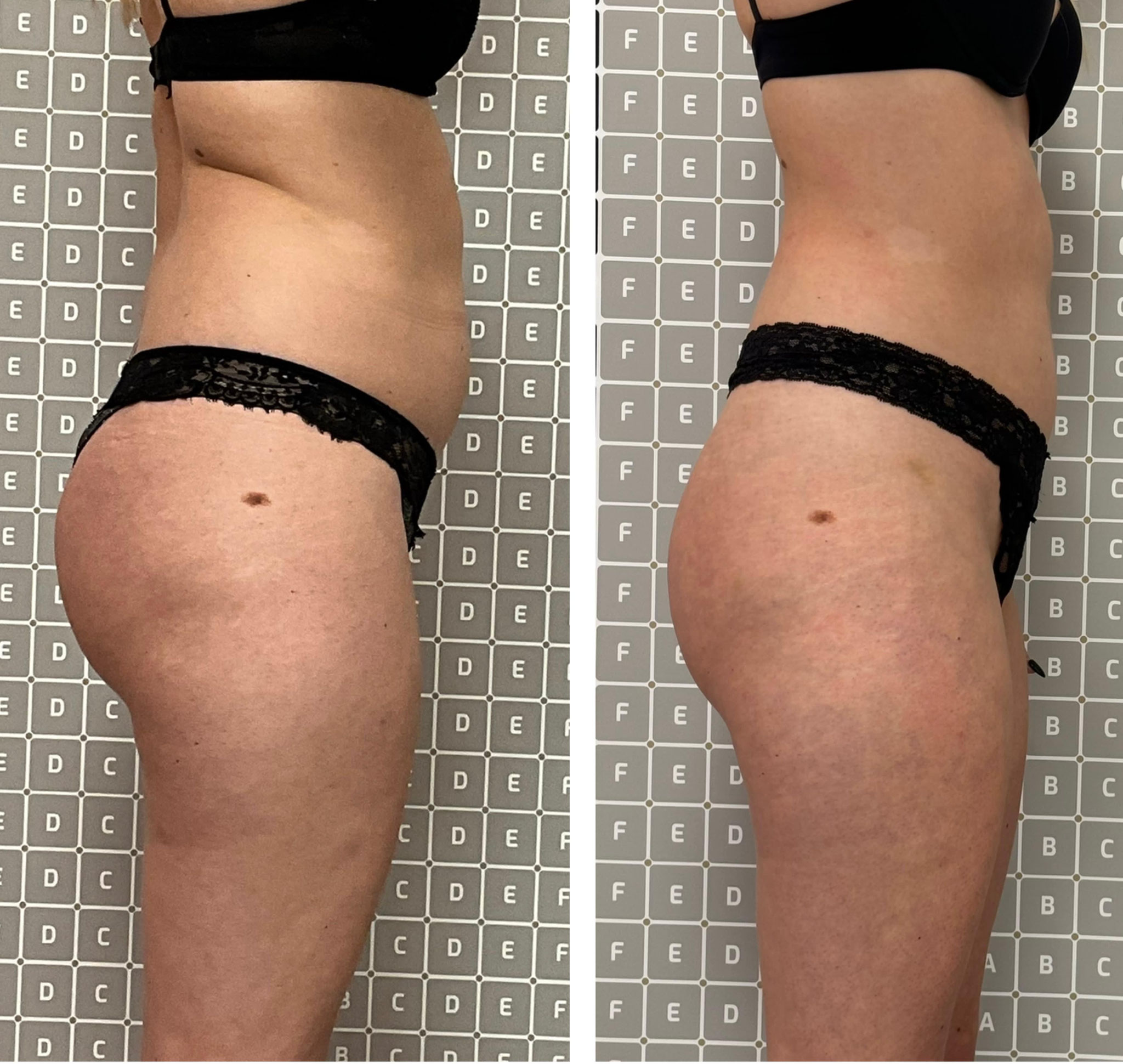 Vorher-Nachher-Ergebnis einer Liposana 3 Plus Körperbehandlung bei Bella's Beauty in Dortmund