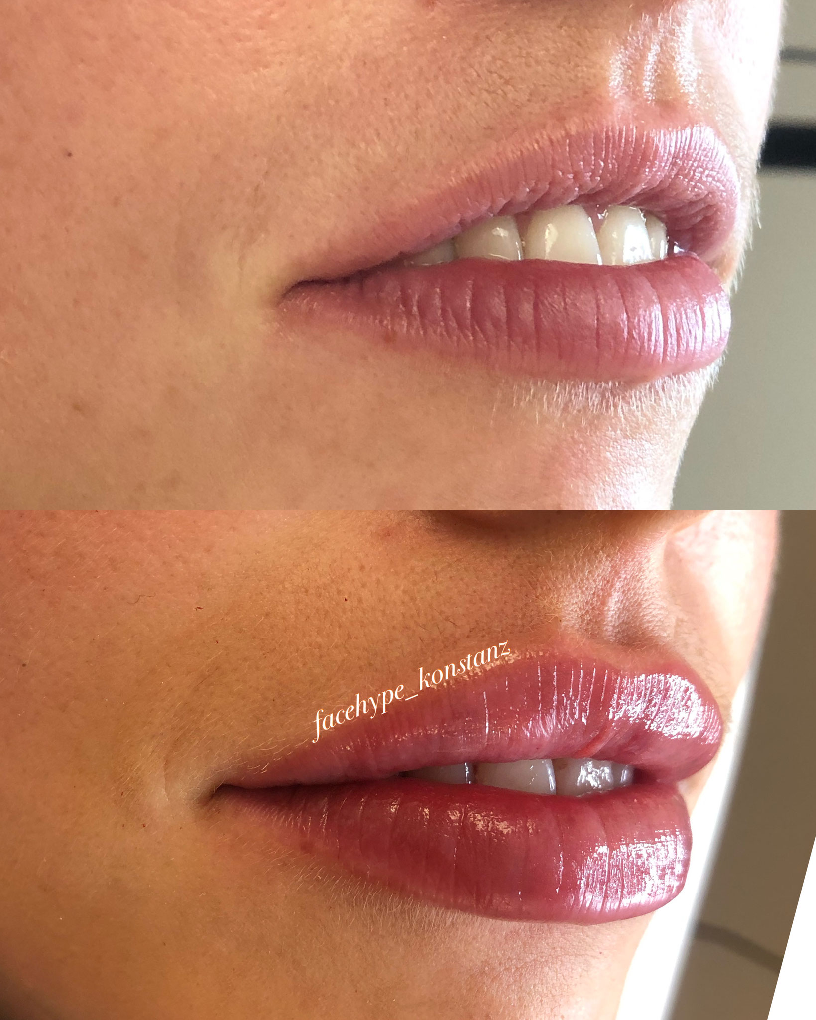 Lippenaufbau mit der FSLL-Technik