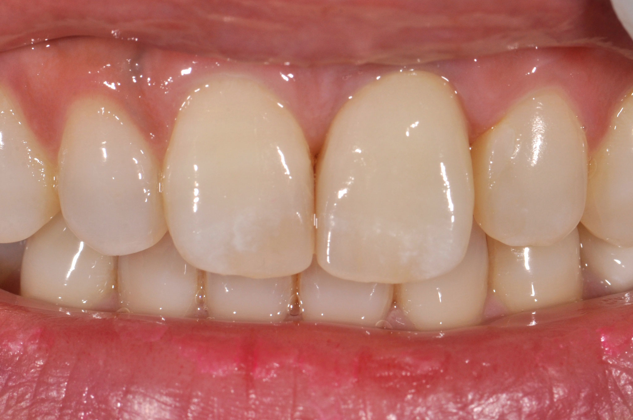 Case-1 After