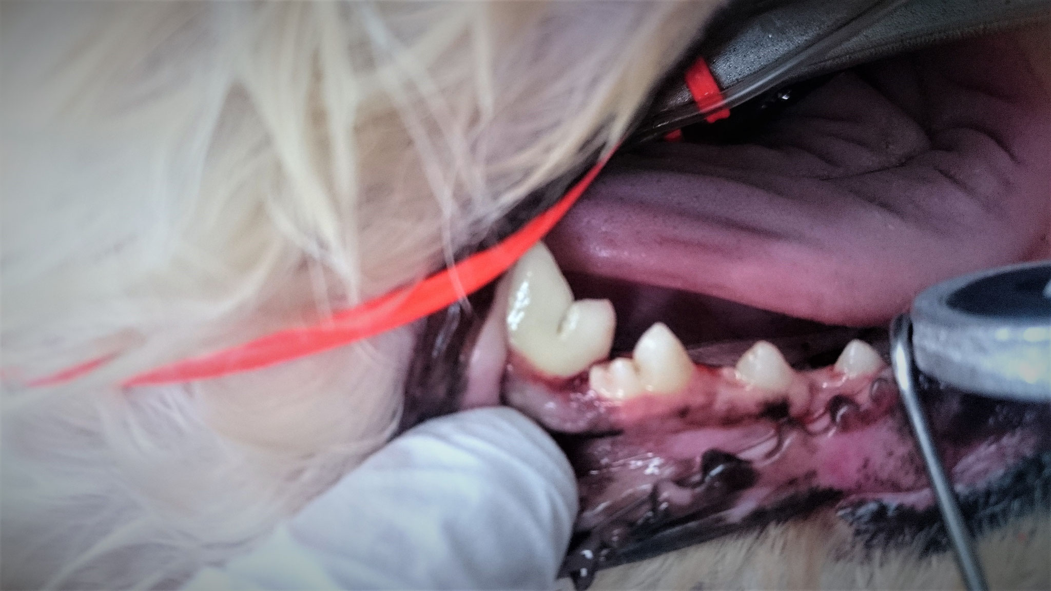 右下の奥歯の歯肉炎と歯周ポケットが存在し、ポケット内に歯石や歯垢が詰まっていました。