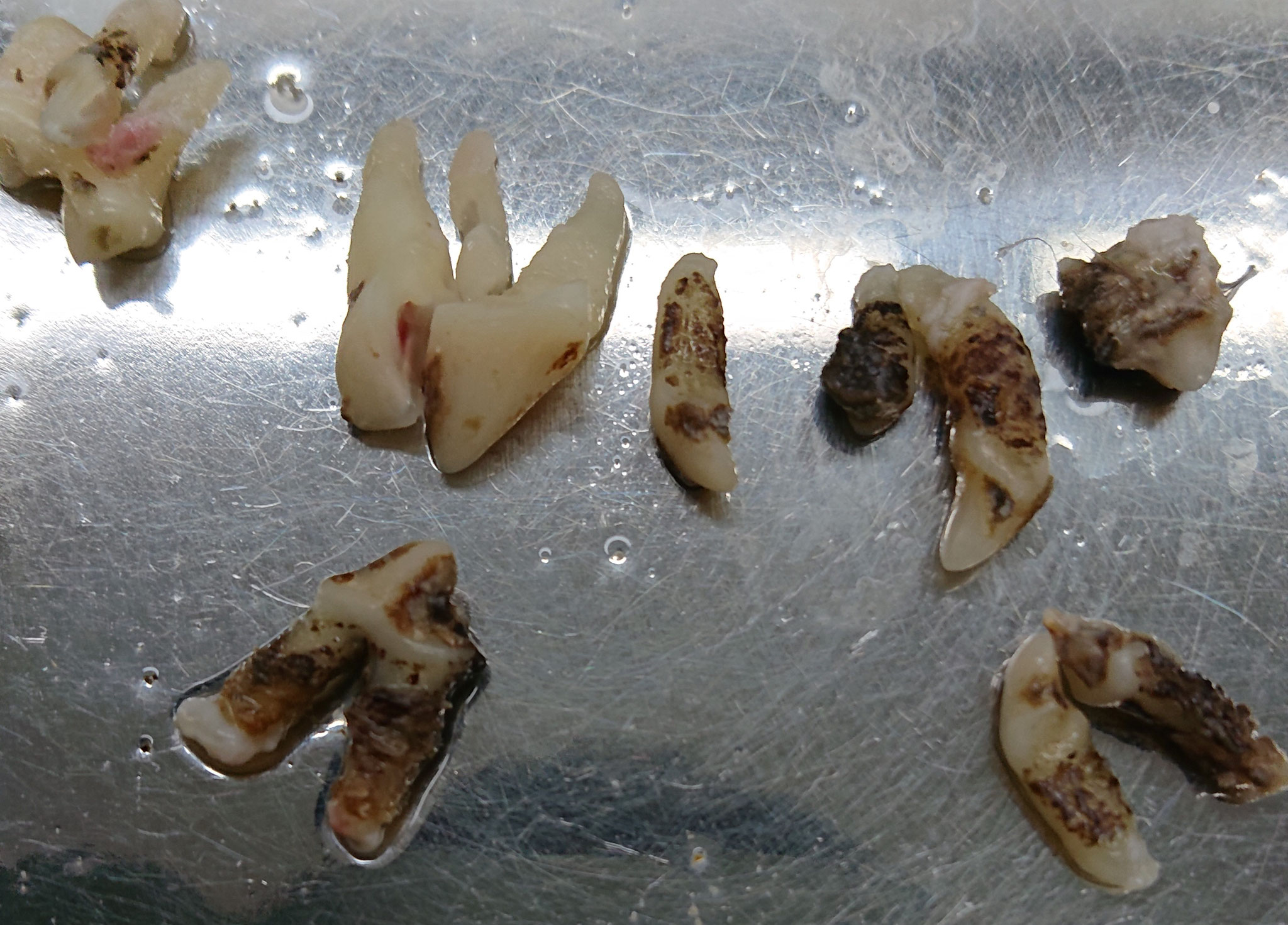 数本の抜歯（一部奥歯は分割抜歯してあります）