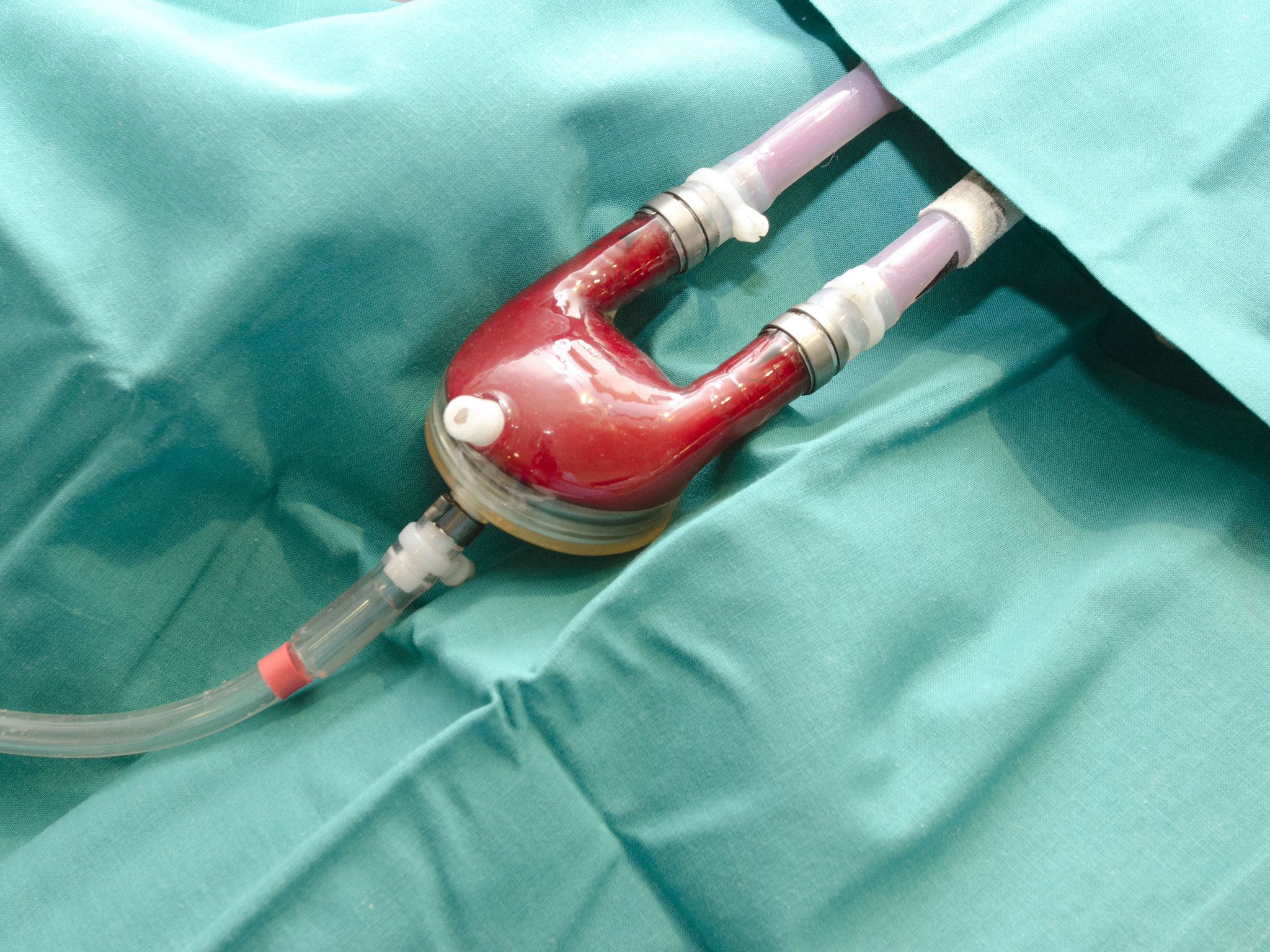 Asistencia Ventricular Pediatrica