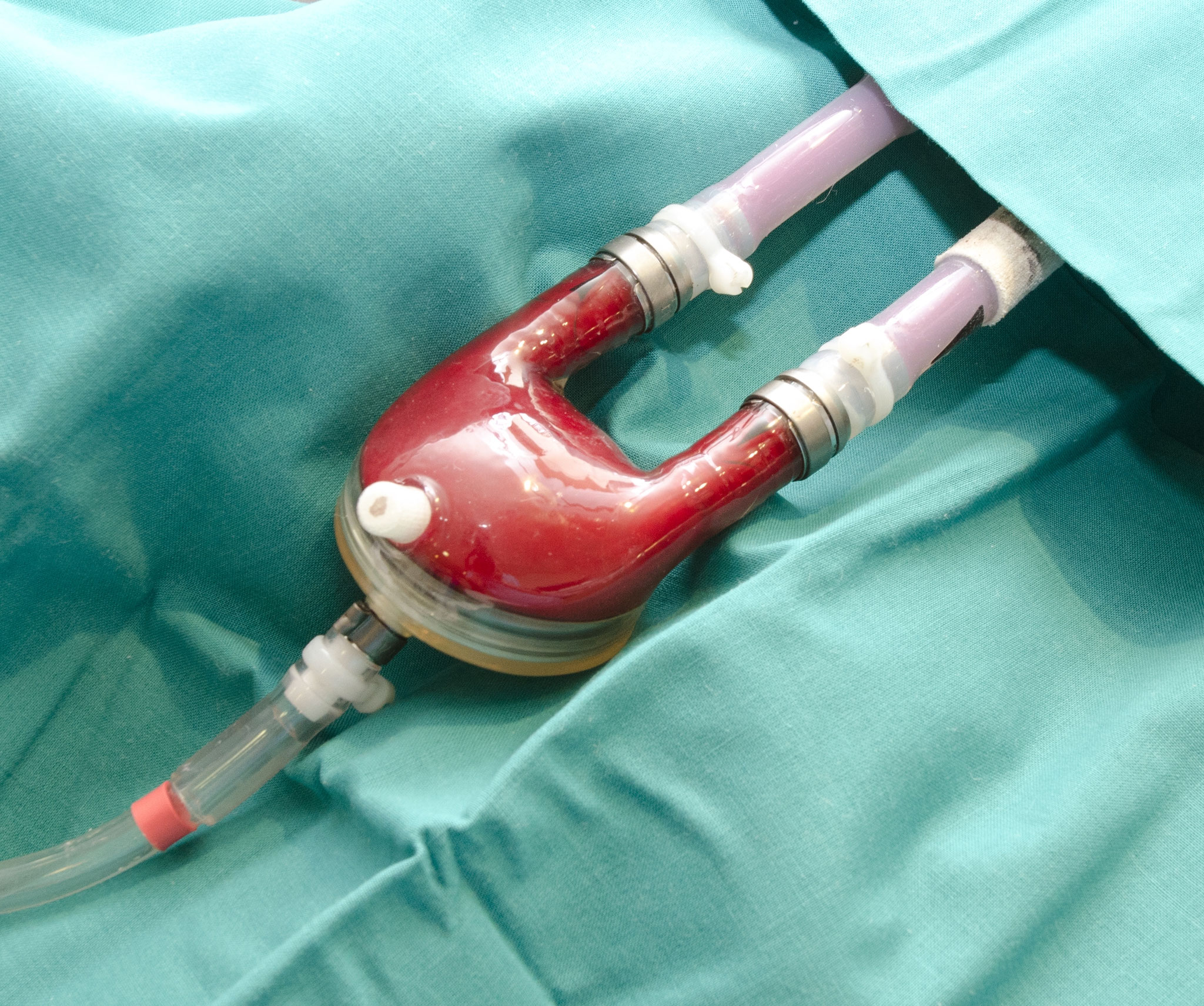 Asistencia ventricular. Berlin Heart