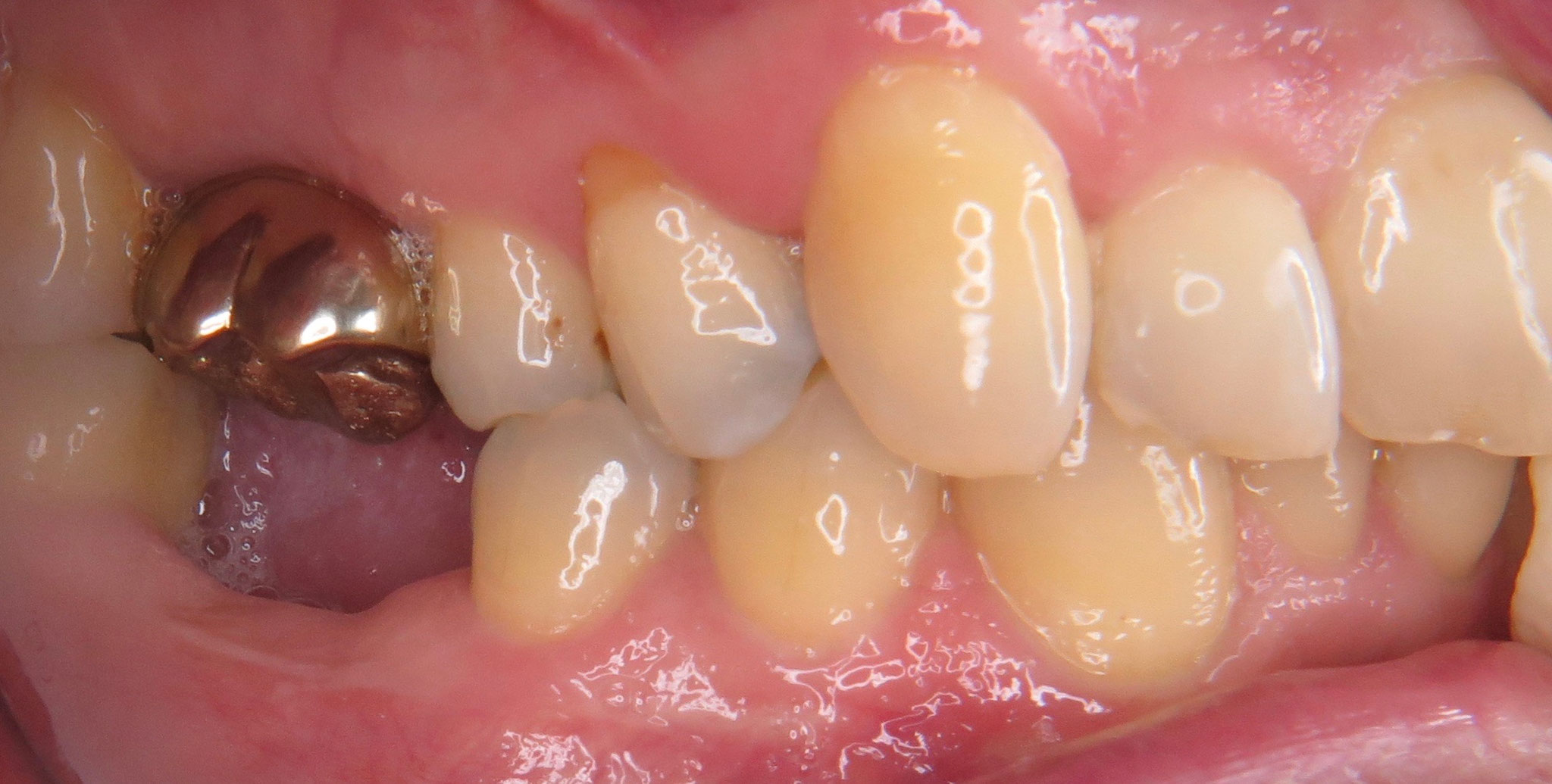 Fehlender Seitenzahn im Unterkiefer ersetzt durch ein Keramikimplantat der Implantatexperte