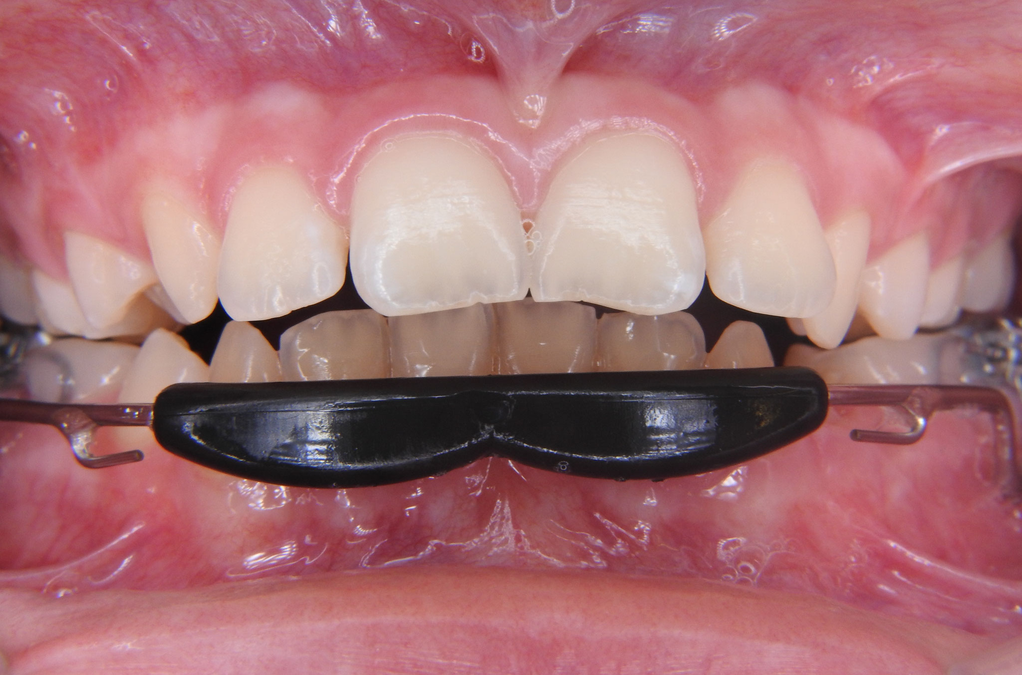 Lipbumper Kieferorthopädiepraxis