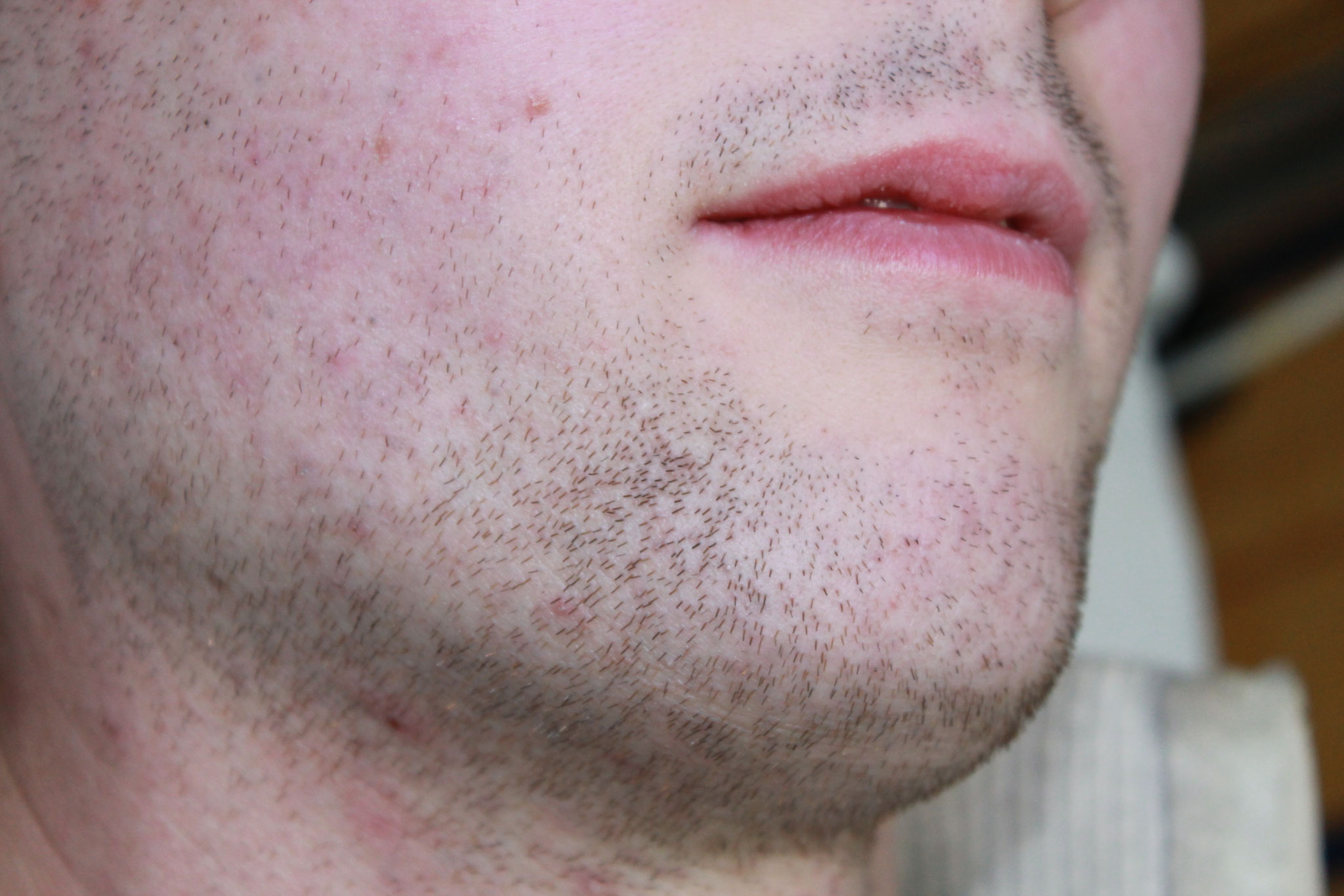 Vor Behandlungsbeginn durch Elektro-Epilation 2018