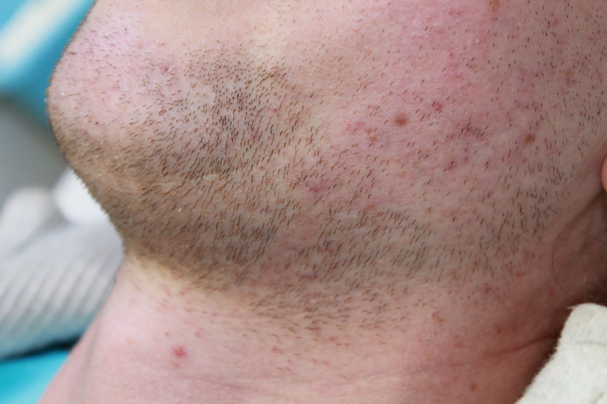 Vor Behandlungsbeginn durch Elektro-Epilation 2018