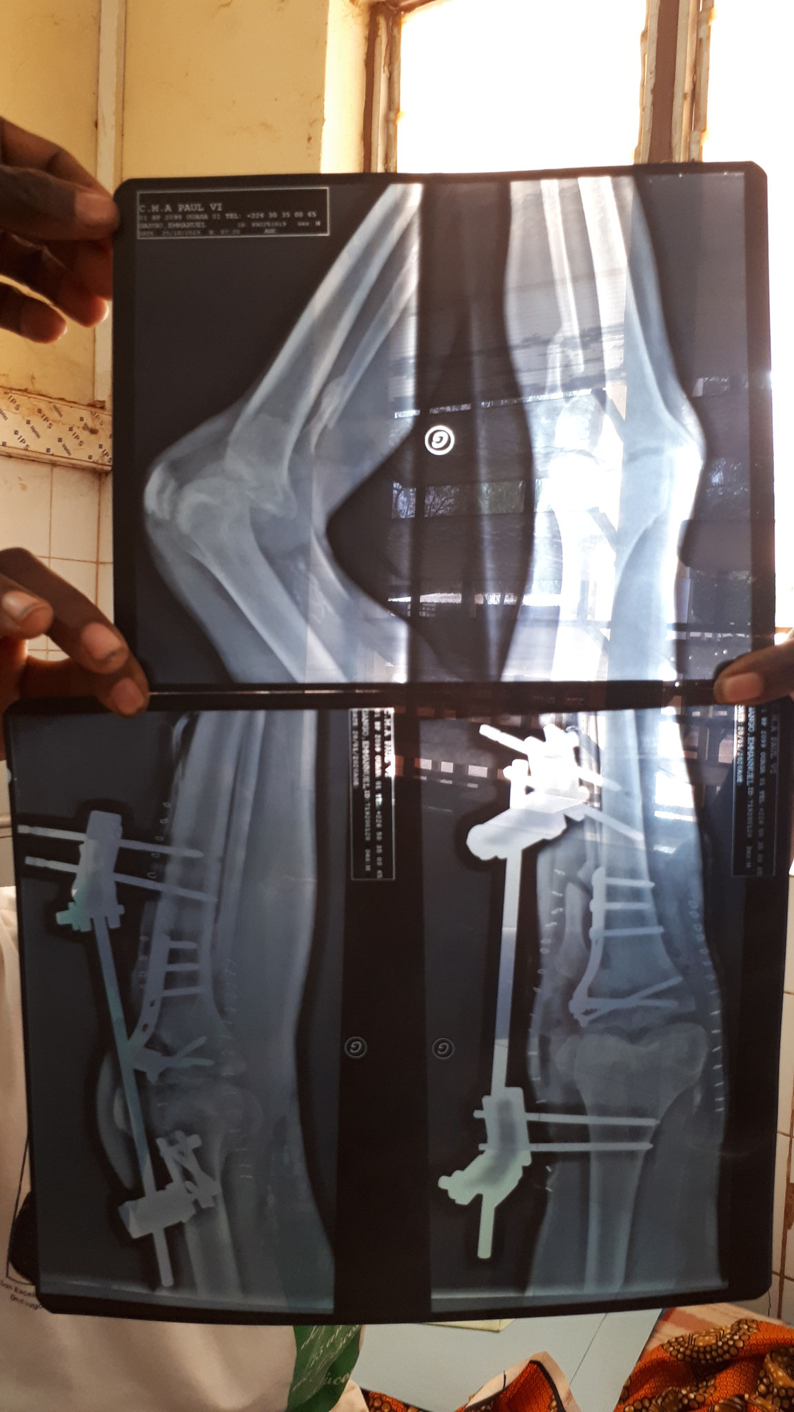 Aufgrund eines schweren Unfalls erlitt ein junger Familienvater einen offenen Knochenbruch. Da er nie von Fachleuten behandelt wurde, konnte er das Knie nicht mehr bewegen.